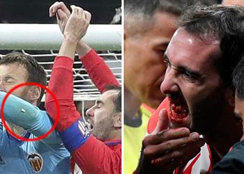 مدافع أتلتيكو مدريد يفقد أسنانه خلال مواجهة فالنسيا