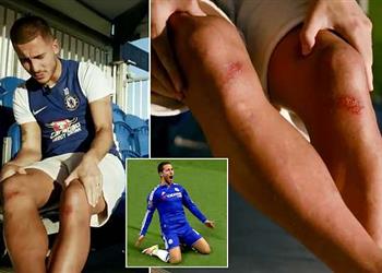 هازارد بعد إصابته لن أحتفل بتلك الطريقة مجدد ا