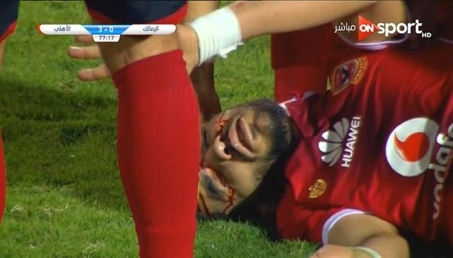 دماء ازارو تسيل في مباراة الاهلي والزمالك